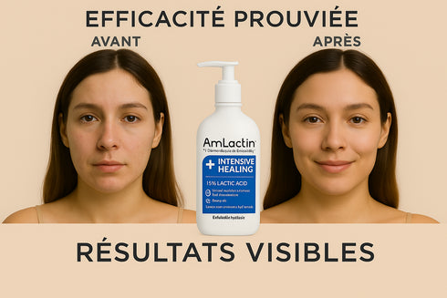 Avant/Après AmLactin Intensive Healing 15% acide lactique - transformation peau réparation intense visible
